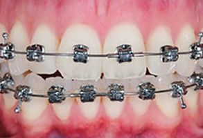 The image displays a close-up view of a person s teeth with braces, featuring metal wires and clear plastic aligners.