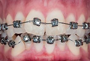 The image displays a close-up of a person s teeth, showcasing a set of braces with multiple metal brackets and wire segments.