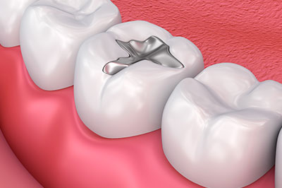 An image of a dental implant in the process of being installed within a tooth root, set against a background of the oral cavity with teeth and gums.