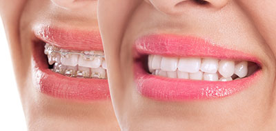 Woman s smiling face with pink lipstick, showcasing teeth alignment and braces.