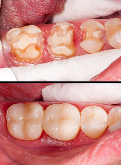 The image shows a close-up of a person s mouth with teeth that appear to be in poor condition, possibly indicating dental decay or neglect.