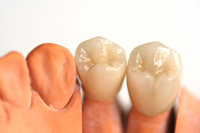 The image shows a close-up of two artificial teeth with visible dental implants, placed side by side against a plain background.