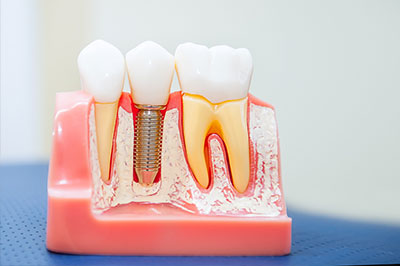 The image shows a close-up of a dental model with several teeth, some of which have fillings and one has an implant.