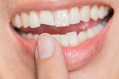 A person with a bright smile holding their finger under their teeth, showcasing a dental implant.