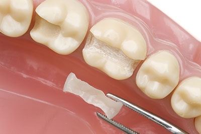 The image shows a close-up of a dental implant in the process of being placed, with a small amount of debris or tooth material visible on the implant.