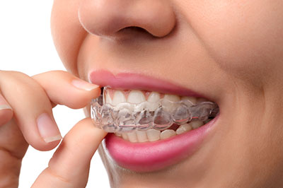 A woman with a smile, wearing an orthodontic appliance, is holding it up to her teeth.