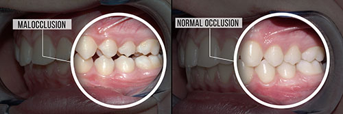 The image shows a side-by-side comparison of a mouth with teeth in the top half and a mouth without teeth in the bottom half, with annotations indicating  malocclusion  in one and  normal occlusion  in the other.