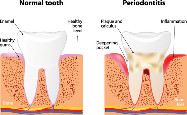 The image is a scientific diagram comparing normal tooth structure to that affected by periodontitis, showing the progression of bone loss around teeth and the presence of inflammation.