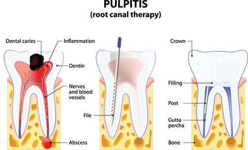 The image shows a diagrammatic illustration of a pulpitis, which is an inflammation of the root canal therapy in a tooth. It s labeled with scientific terms and includes cross-sections of teeth at different stages of treatment or infection, highlighting the progression from dental caries to the removal of infected tissue.