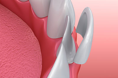 The image shows a close-up of a dental implant with an abutment, which is the connecting piece between the implant and the crown or bridgework.