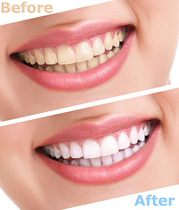 The image shows a woman s smile before and after teeth whitening, highlighting the transformation with text.