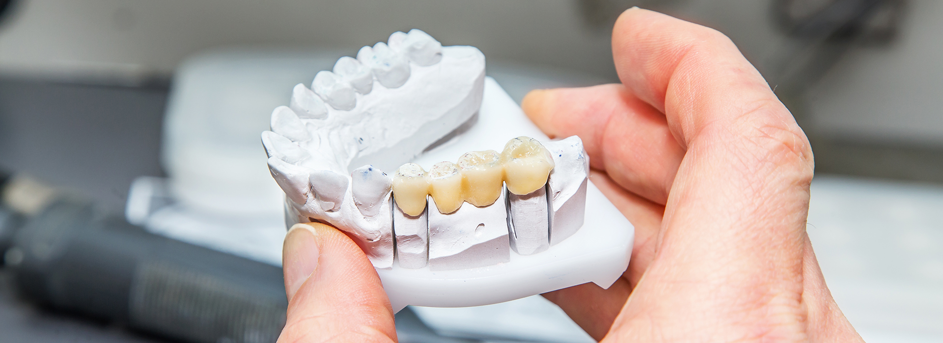 The image shows a human hand holding a 3D printed dental implant with multiple teeth attachments, against a blurred background.