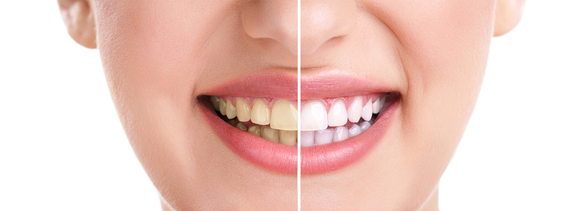 The image shows a close-up of a person s face with a focus on their teeth, highlighting the before and after effects of dental treatment.