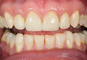 Image of a close-up view of a person s teeth, showing yellowing and possible dental issues.