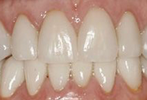 The image displays a close-up view of a person's teeth, showcasing a bright white smile with visible enamel and some minor staining on the lower front teeth.