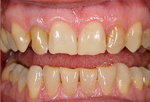 The image displays a close-up of a person s teeth with yellowing and staining, emphasizing the need for dental care or cosmetic dentistry.