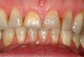 The image shows a close-up of a person s teeth with visible staining and yellowing, which suggests poor oral hygiene or the need for professional dental care.