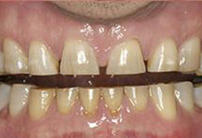 The image displays a close-up of a person's teeth with visible dental work, including a bridge and possibly crowns, set against a blurred background.